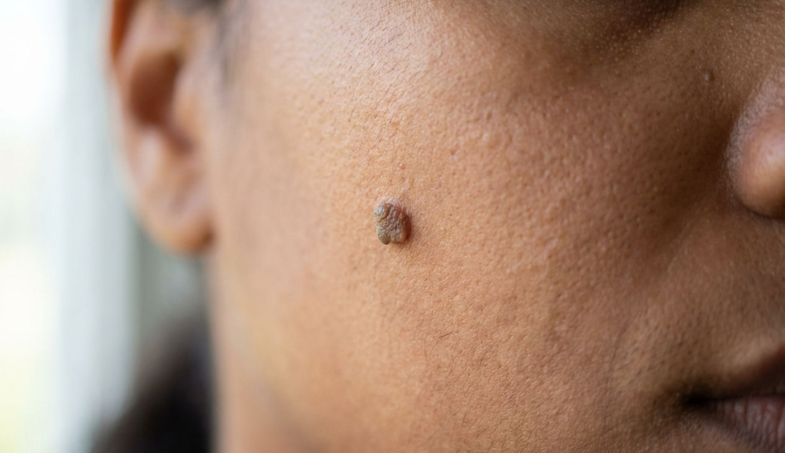 How to Get Rid of Skin Tags Naturally?